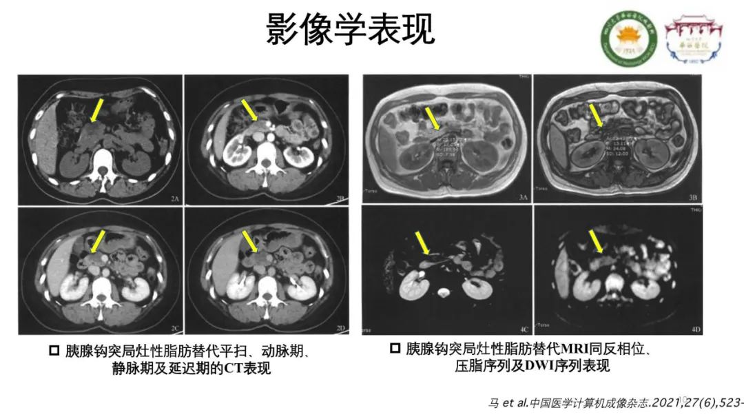 影像PPT - 【病例】胰腺脂肪替代1例CT影像-10