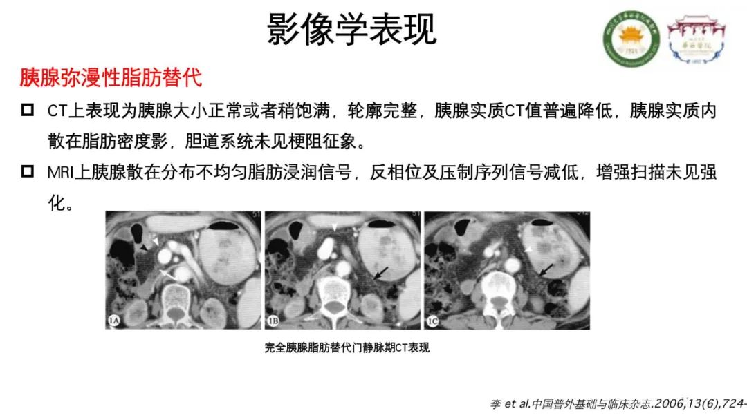 影像PPT - 【病例】胰腺脂肪替代1例CT影像-11