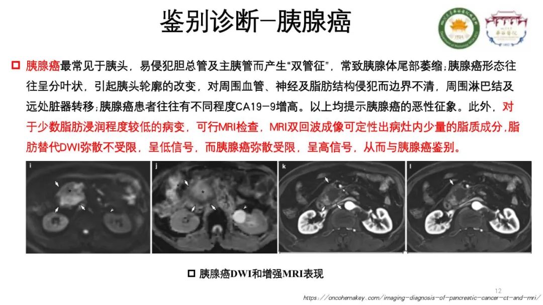 影像PPT - 【病例】胰腺脂肪替代1例CT影像-12