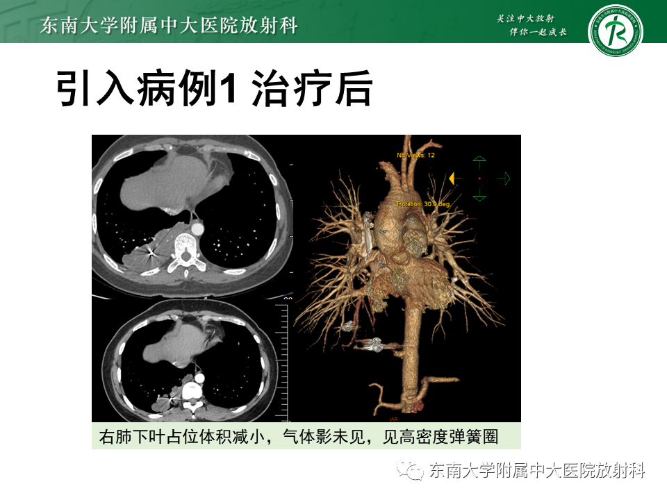 影像PPT - 【PPT】肺隔离症-3
