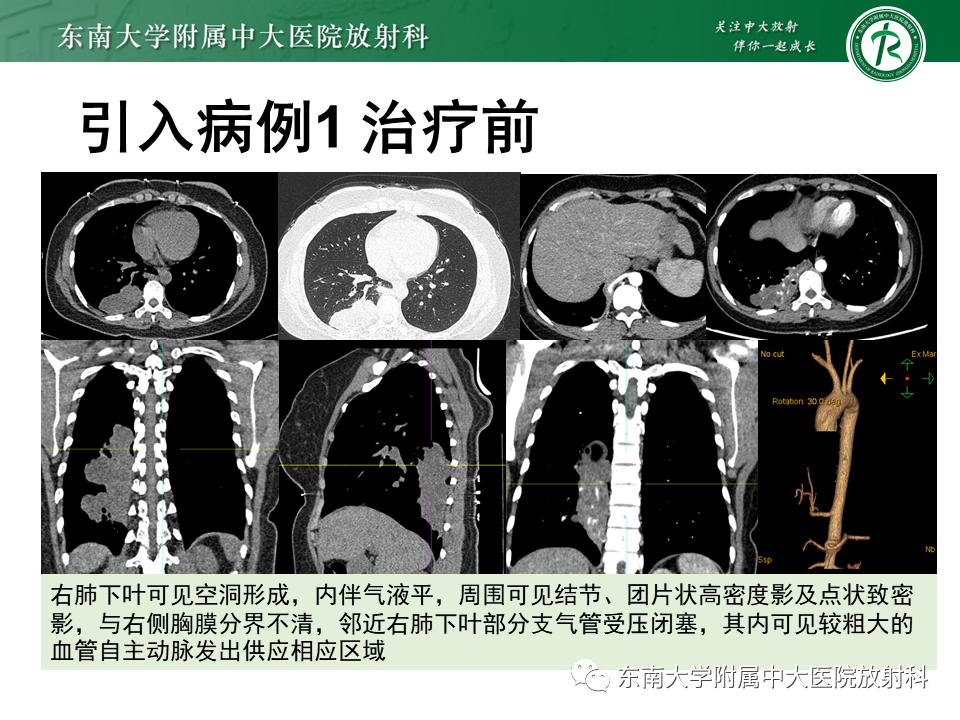 影像PPT - 【PPT】肺隔离症-2