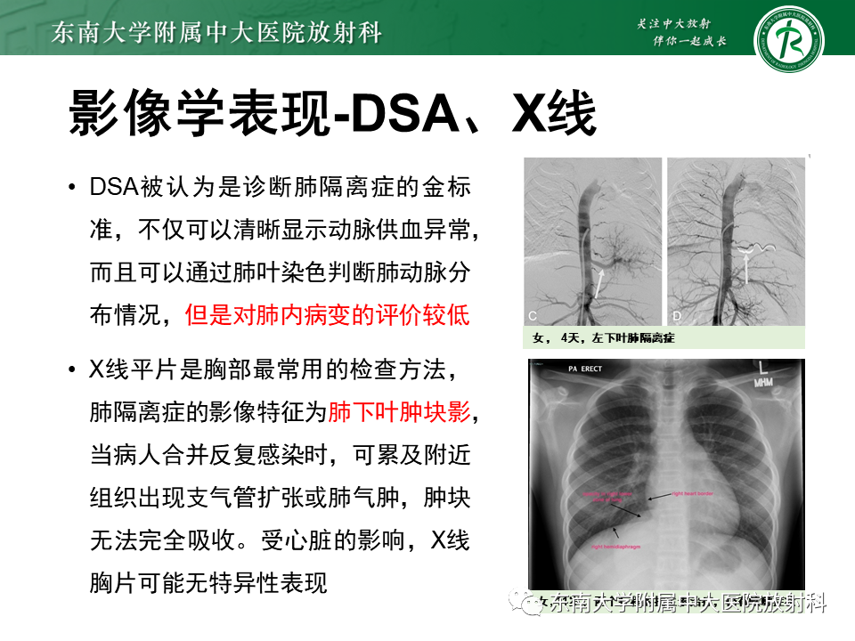 影像PPT - 【PPT】肺隔离症-10