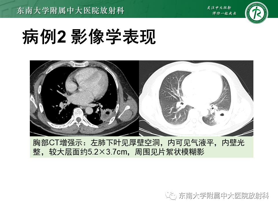 影像PPT - 【PPT】肺隔离症-16