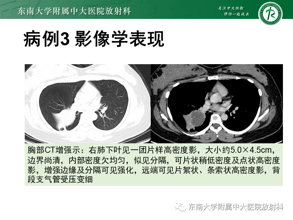 影像PPT - 【PPT】肺隔离症-21
