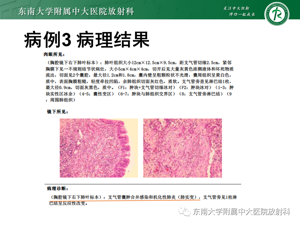 影像PPT - 【PPT】肺隔离症-22