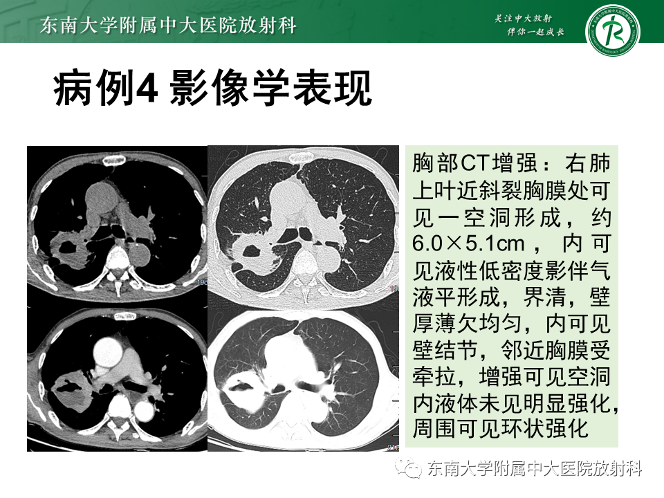 影像PPT - 【PPT】肺隔离症-26