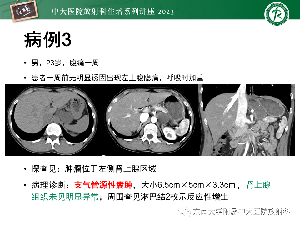 影像PPT - 【PPT】腹膜后原发囊性病变影像诊断思路-4