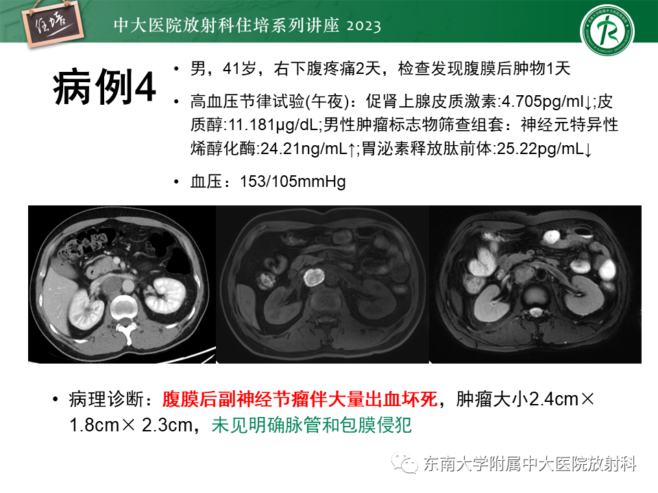 影像PPT - 【PPT】腹膜后原发囊性病变影像诊断思路-5