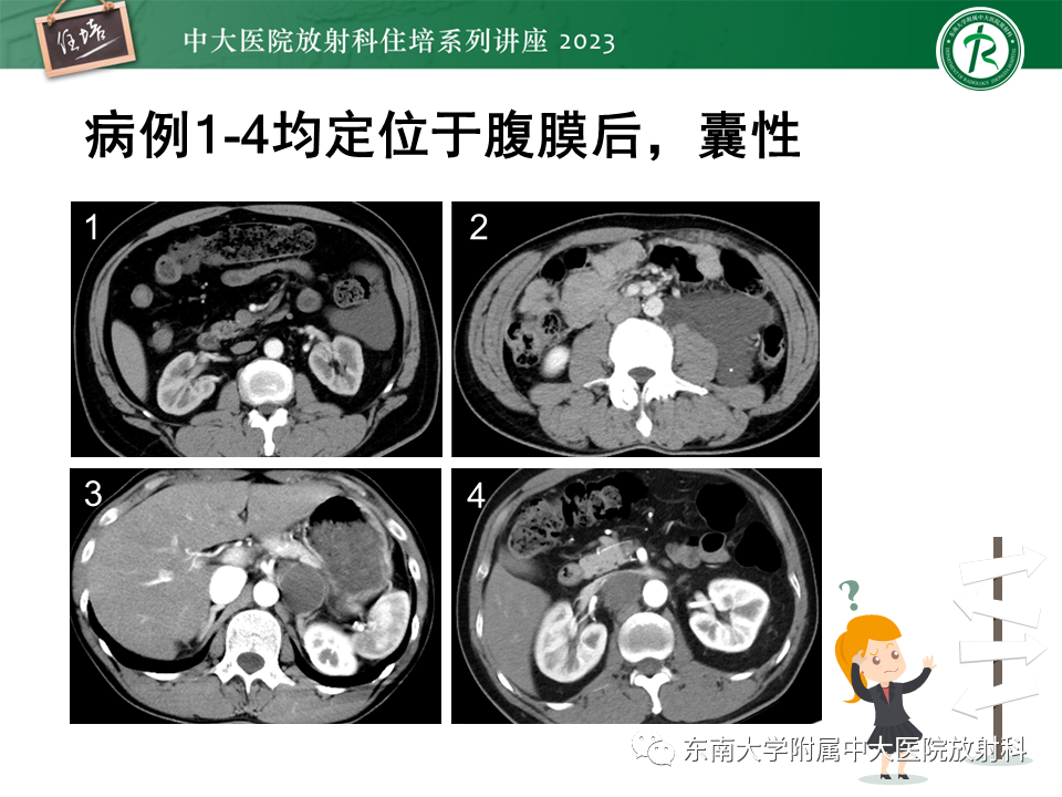 影像PPT - 【PPT】腹膜后原发囊性病变影像诊断思路-6