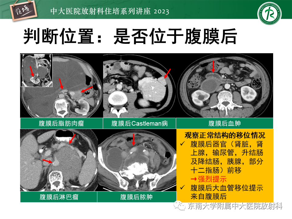 影像PPT - 【PPT】腹膜后原发囊性病变影像诊断思路-11