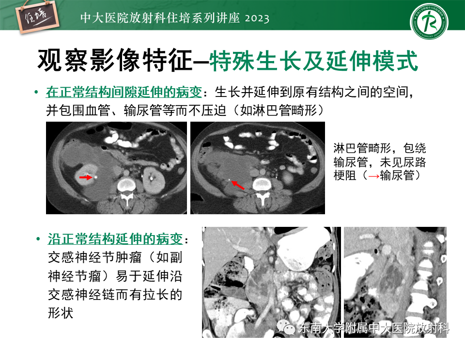影像PPT - 【PPT】腹膜后原发囊性病变影像诊断思路-16