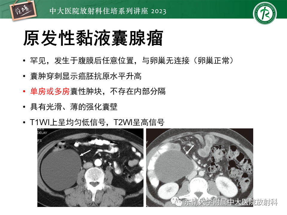 影像PPT - 【PPT】腹膜后原发囊性病变影像诊断思路-25