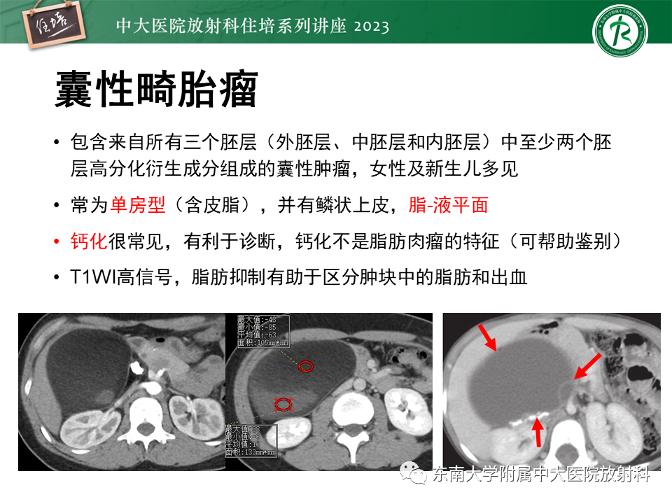 影像PPT - 【PPT】腹膜后原发囊性病变影像诊断思路-27