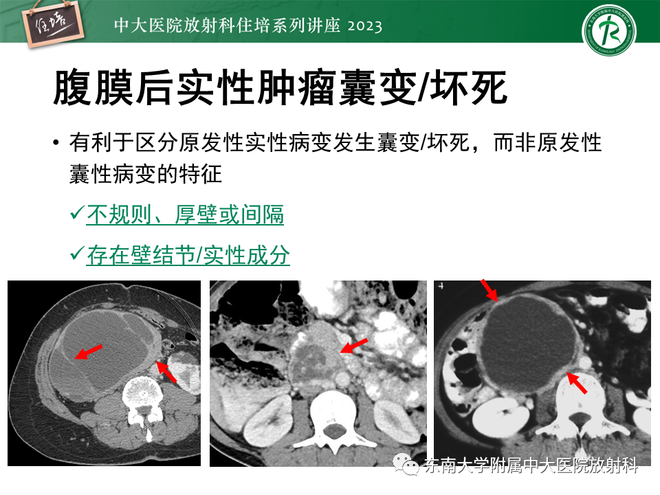 影像PPT - 【PPT】腹膜后原发囊性病变影像诊断思路-31