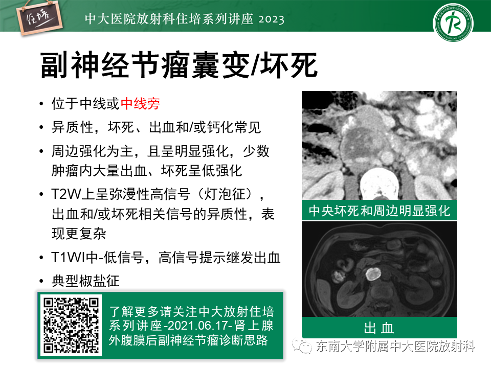 影像PPT - 【PPT】腹膜后原发囊性病变影像诊断思路-32
