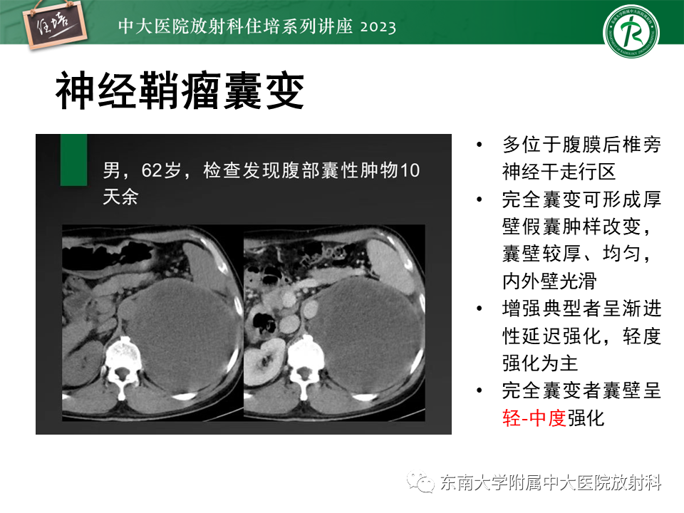 影像PPT - 【PPT】腹膜后原发囊性病变影像诊断思路-33