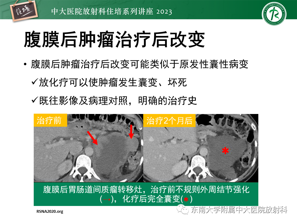 影像PPT - 【PPT】腹膜后原发囊性病变影像诊断思路-34