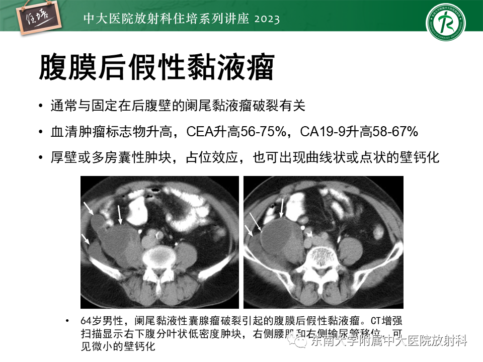 影像PPT - 【PPT】腹膜后原发囊性病变影像诊断思路-35