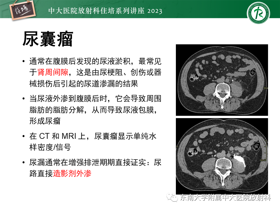 影像PPT - 【PPT】腹膜后原发囊性病变影像诊断思路-38