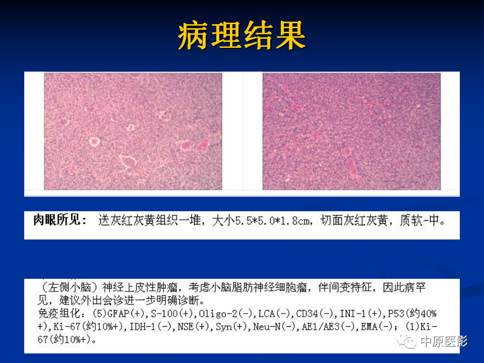 影像PPT - 【病例】小脑脂肪神经细胞瘤1例MR影像-12