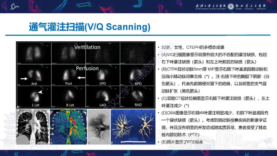 影像PPT - 【PPT】慢性血栓栓塞性肺动脉高压影像诊断-7