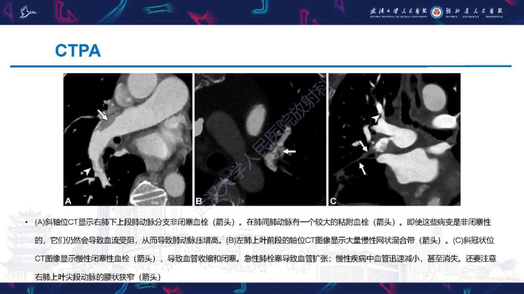 影像PPT - 【PPT】慢性血栓栓塞性肺动脉高压影像诊断-9
