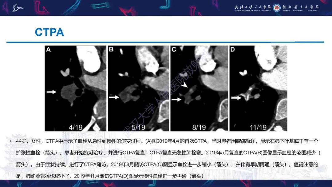 影像PPT - 【PPT】慢性血栓栓塞性肺动脉高压影像诊断-11