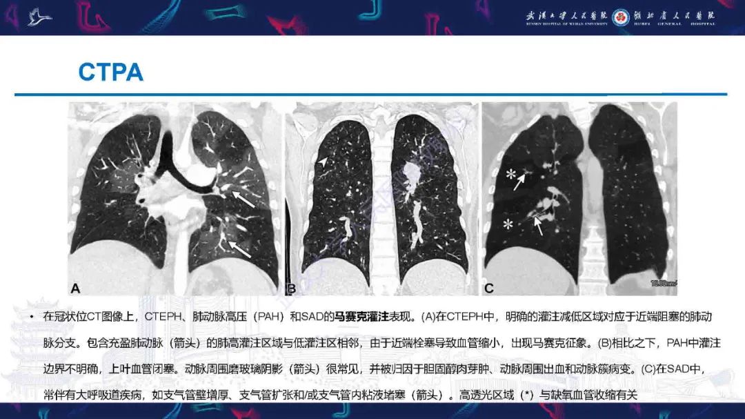 影像PPT - 【PPT】慢性血栓栓塞性肺动脉高压影像诊断-13