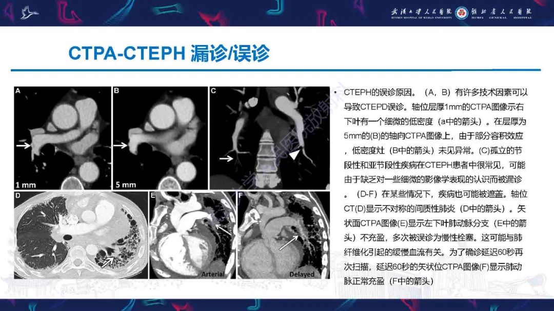 影像PPT - 【PPT】慢性血栓栓塞性肺动脉高压影像诊断-16
