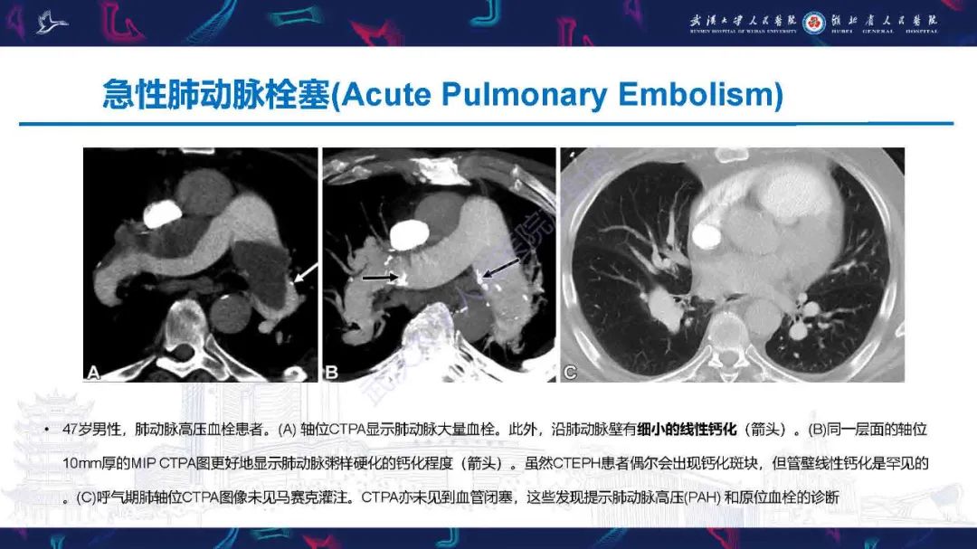 影像PPT - 【PPT】慢性血栓栓塞性肺动脉高压影像诊断-19