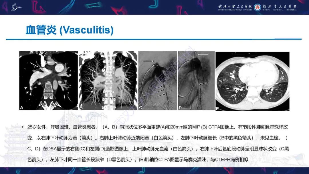 影像PPT - 【PPT】慢性血栓栓塞性肺动脉高压影像诊断-21