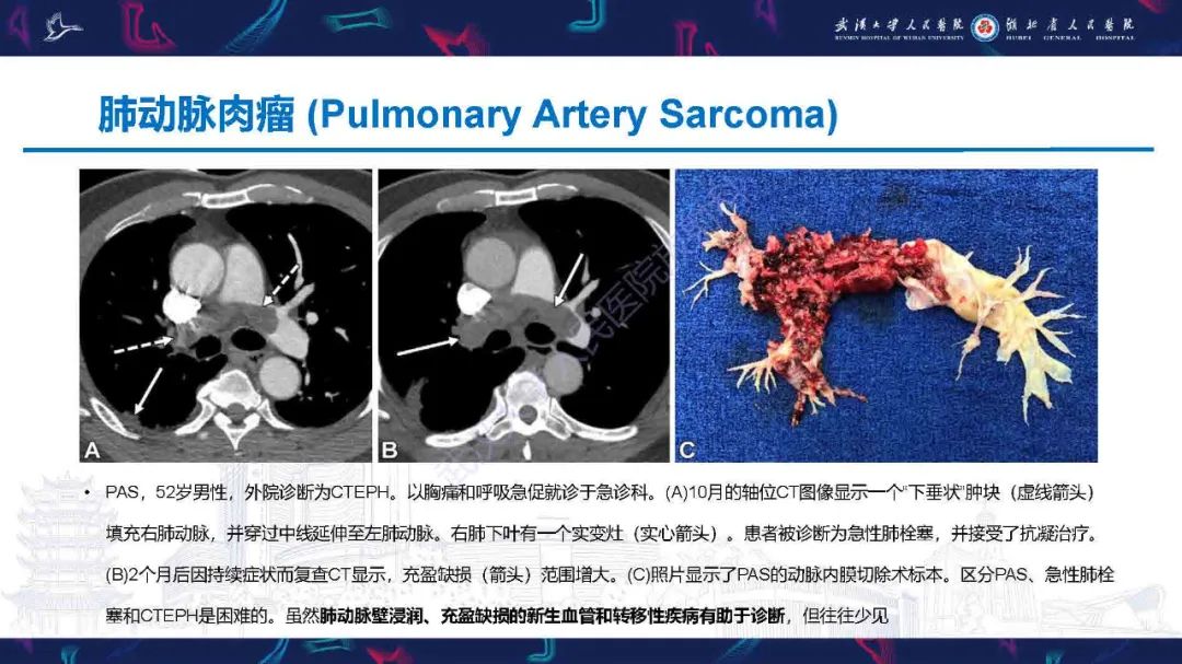 影像PPT - 【PPT】慢性血栓栓塞性肺动脉高压影像诊断-23