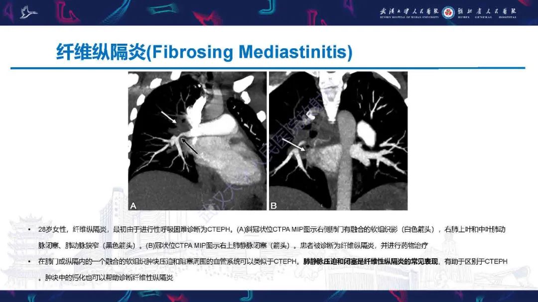 影像PPT - 【PPT】慢性血栓栓塞性肺动脉高压影像诊断-25