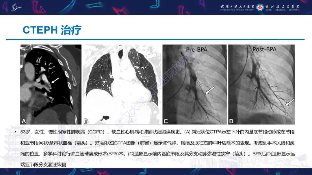 影像PPT - 【PPT】慢性血栓栓塞性肺动脉高压影像诊断-27