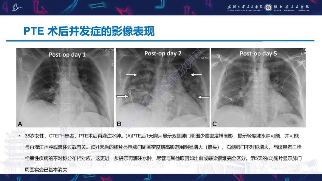 影像PPT - 【PPT】慢性血栓栓塞性肺动脉高压影像诊断-31