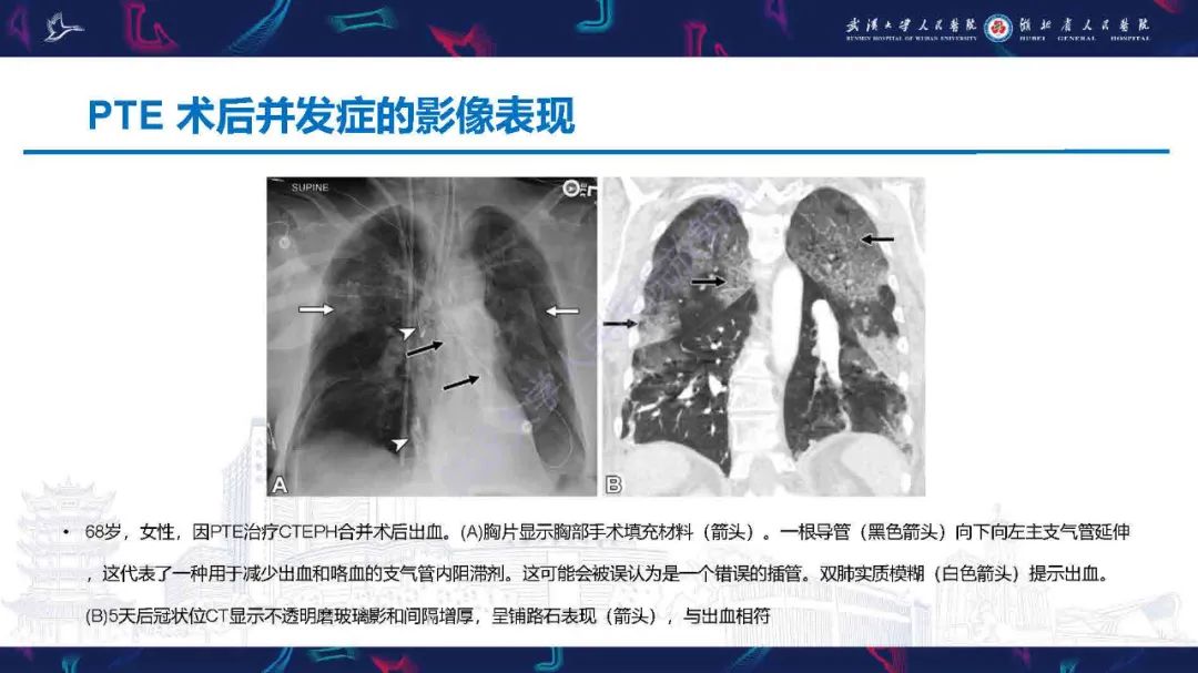 影像PPT - 【PPT】慢性血栓栓塞性肺动脉高压影像诊断-32