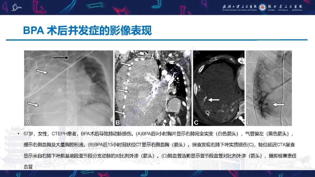 影像PPT - 【PPT】慢性血栓栓塞性肺动脉高压影像诊断-34