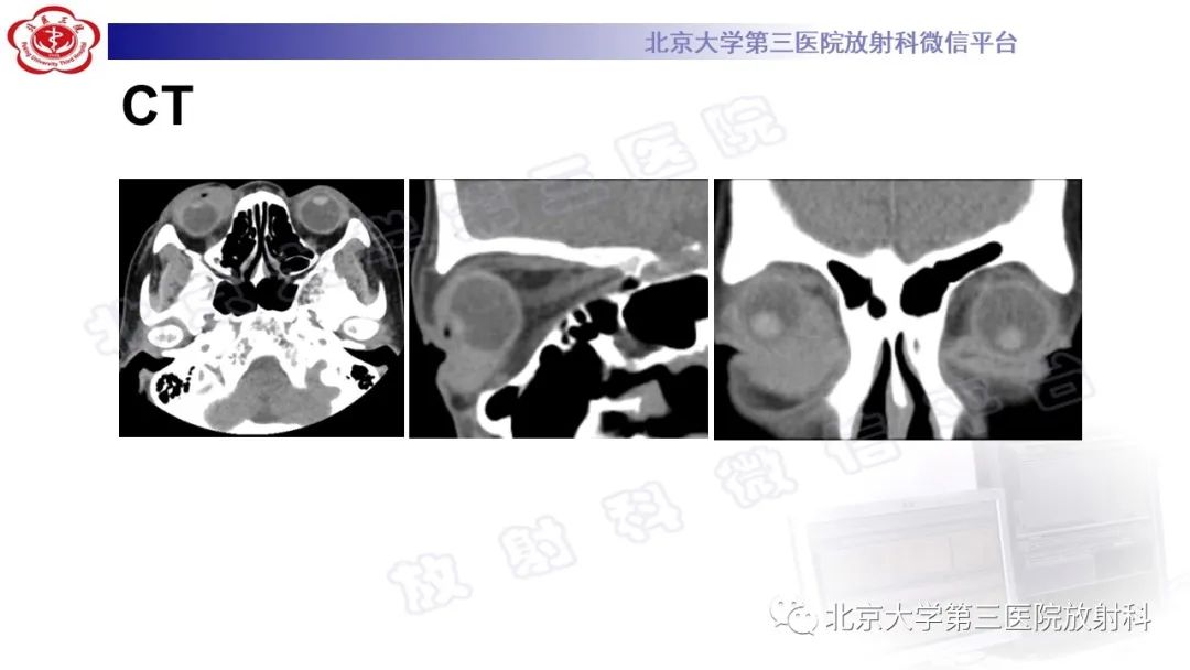 影像PPT - 【PPT】眼附属器淋巴瘤-3