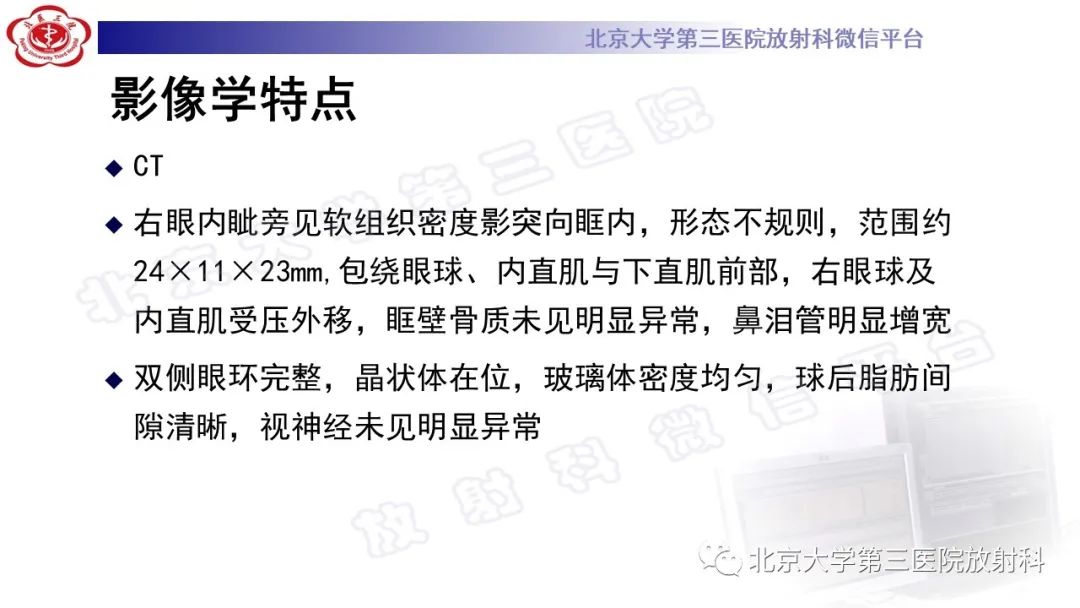 影像PPT - 【PPT】眼附属器淋巴瘤-4