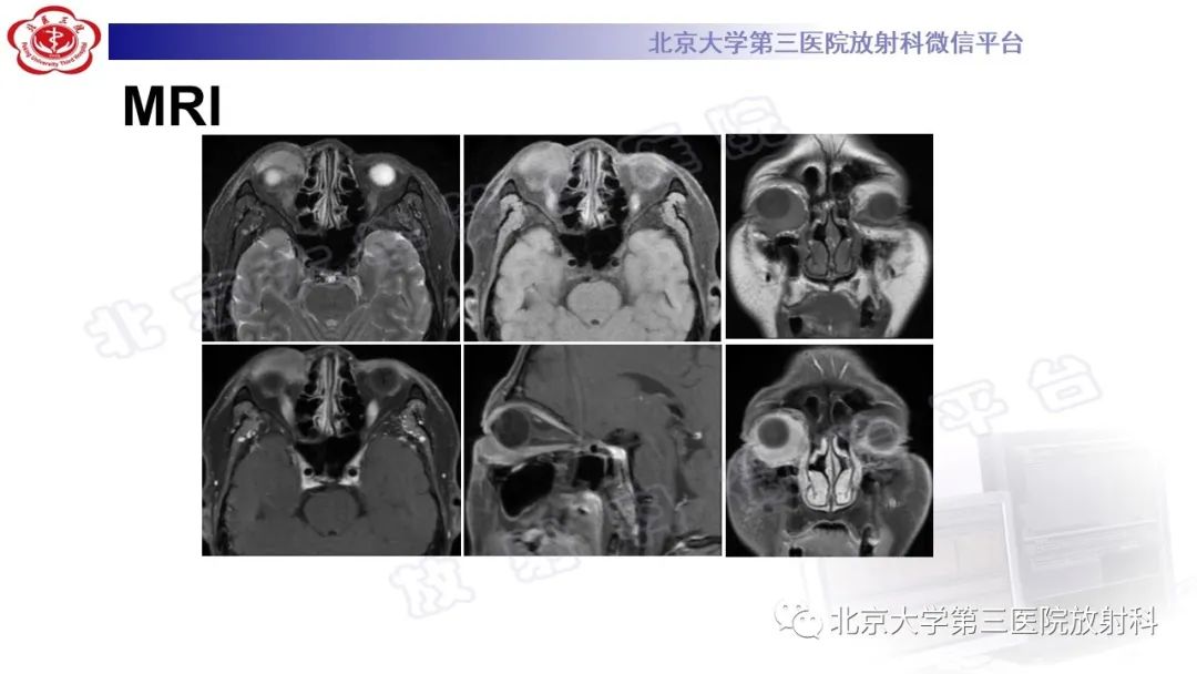 影像PPT - 【PPT】眼附属器淋巴瘤-5