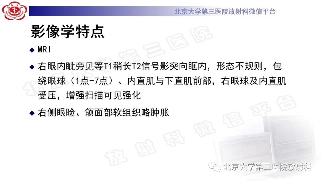 影像PPT - 【PPT】眼附属器淋巴瘤-6