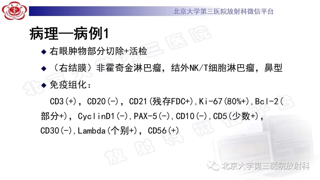 影像PPT - 【PPT】眼附属器淋巴瘤-7