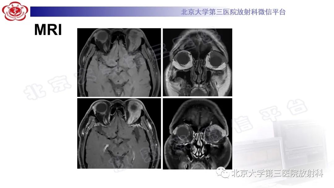 影像PPT - 【PPT】眼附属器淋巴瘤-9