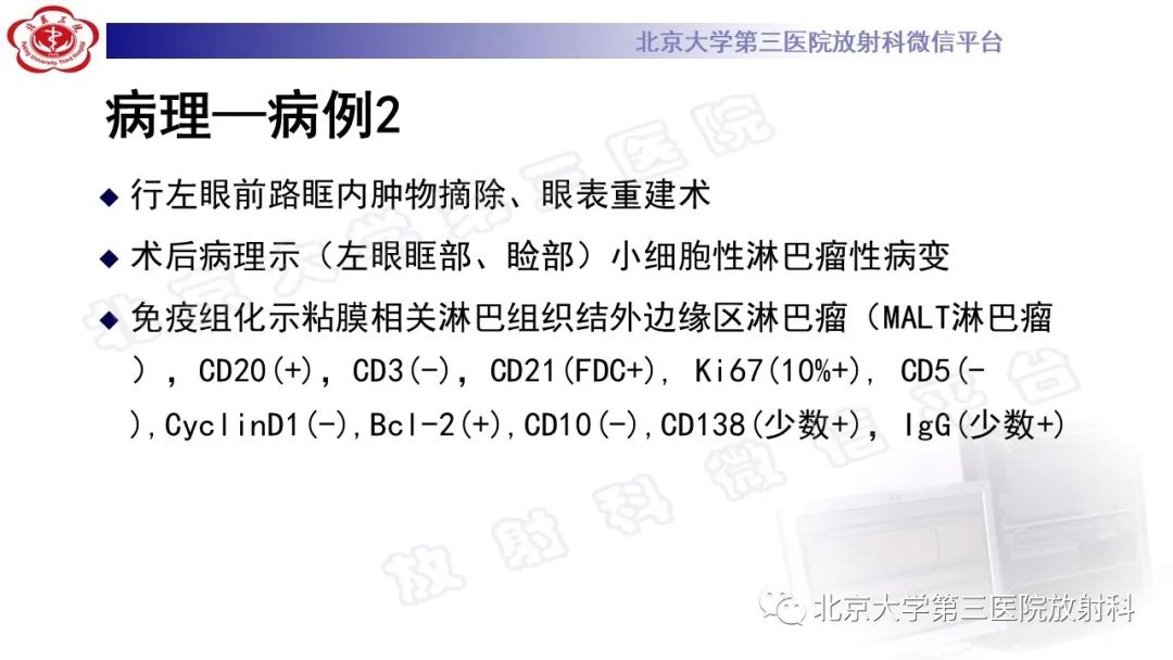 影像PPT - 【PPT】眼附属器淋巴瘤-11