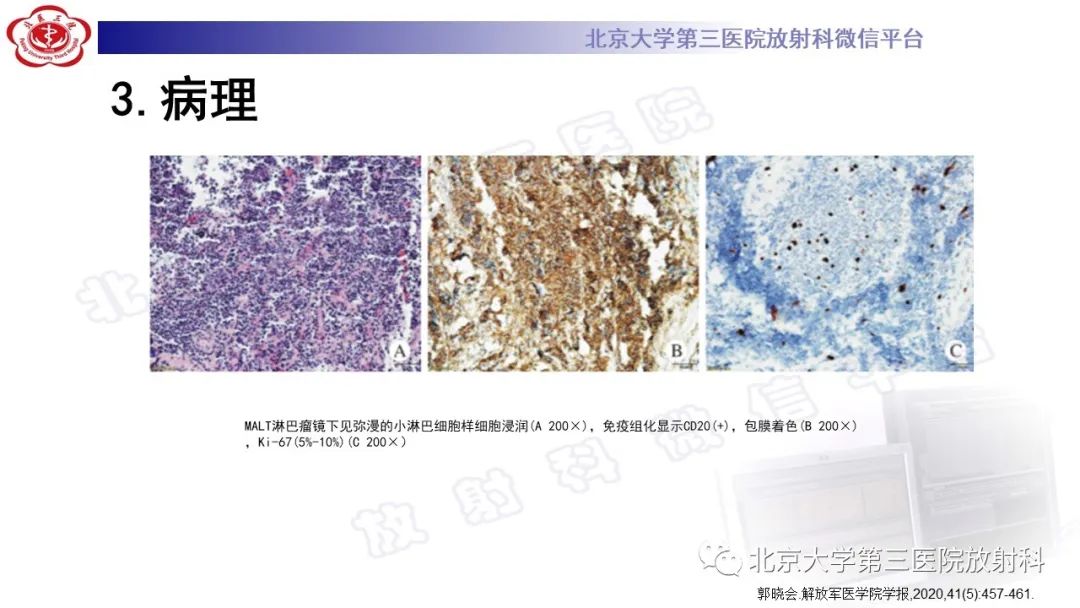 影像PPT - 【PPT】眼附属器淋巴瘤-17
