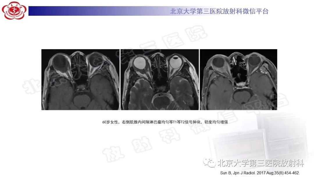 影像PPT - 【PPT】眼附属器淋巴瘤-20