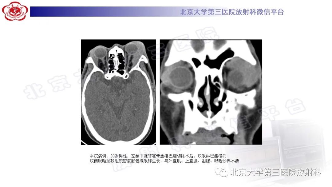 影像PPT - 【PPT】眼附属器淋巴瘤-21