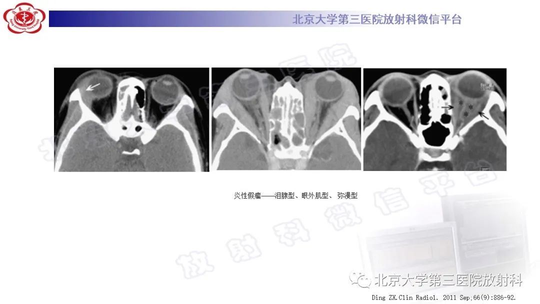 影像PPT - 【PPT】眼附属器淋巴瘤-24