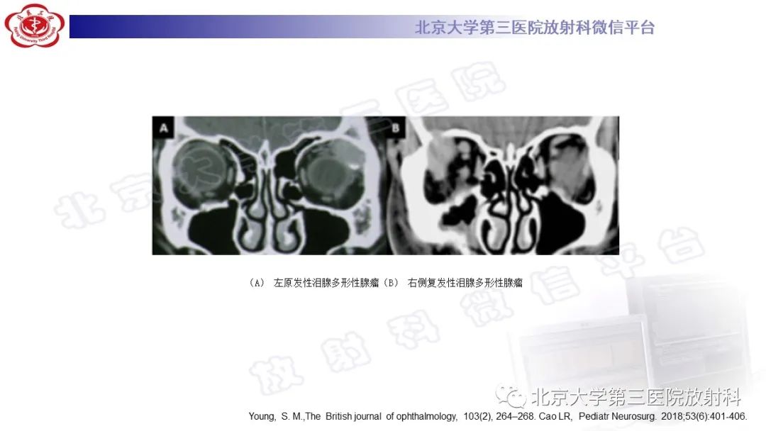 影像PPT - 【PPT】眼附属器淋巴瘤-26