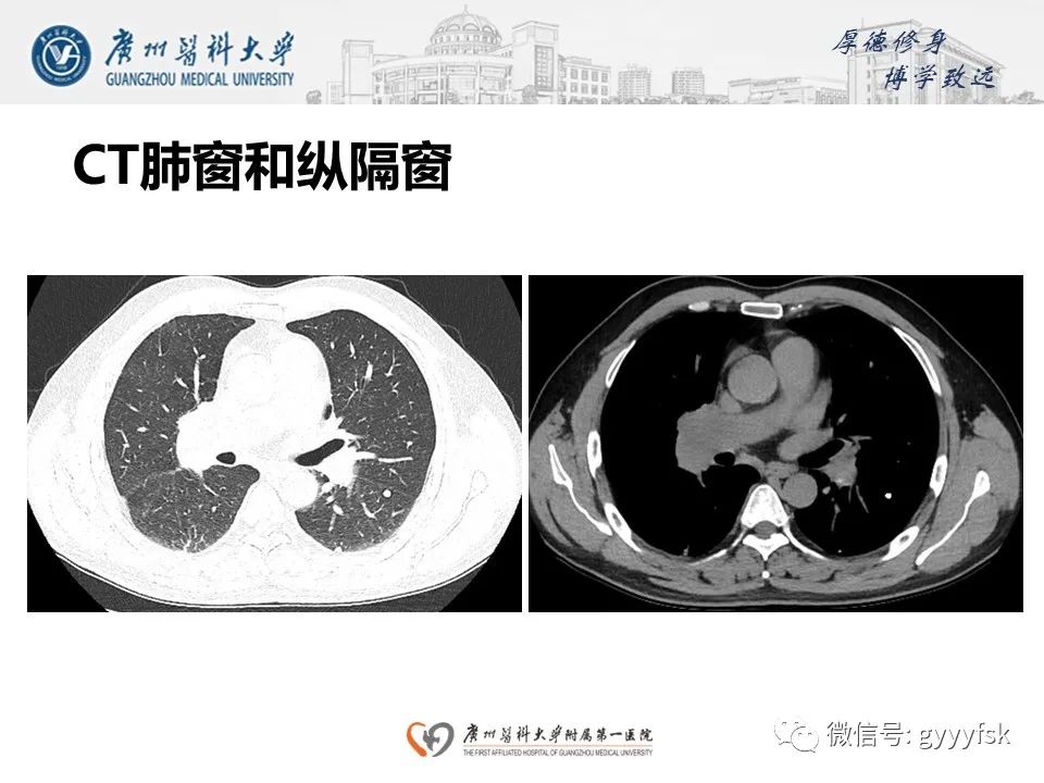 影像PPT - 【病例】肺动脉肉瘤1例CT影像-5
